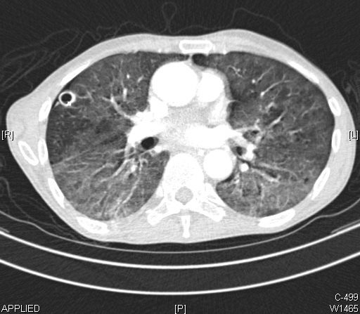 AI could save cancer patients AI could save cancer patients