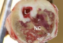 It’s not all about inflammation Lund University Diabetes Centre