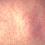 Measles cases in 2017 increased four-fold compared to 2016