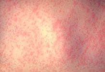 Measles cases in 2017 increased four-fold compared to 2016
