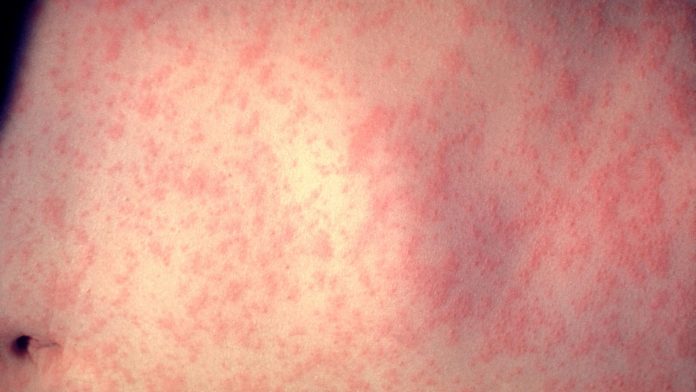 Measles cases in 2017 increased four-fold compared to 2016