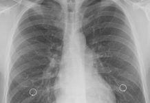 Young adults at greater risk of developing infectious tuberculosis