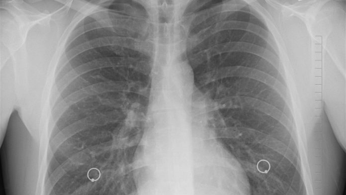 Young adults at greater risk of developing infectious tuberculosis