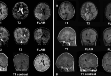 Review for MS drug Zinbryta after cases of inflammatory brain disorders Review for MS drug Zinbryta after cases of inflammatory brain disorders