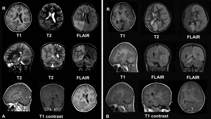 Review for MS drug Zinbryta after cases of inflammatory brain disorders