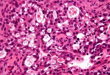 Leukaemia anti-cancer drug may work against rare ovarian cancer Leukaemia anti-cancer drug may work against rare ovarian cancer