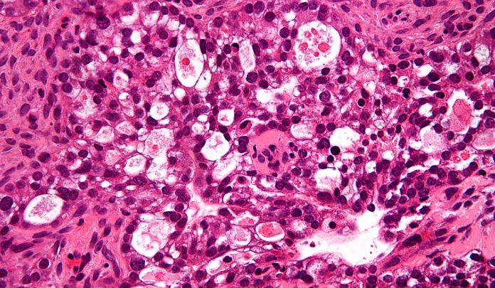 Leukaemia anti-cancer drug may work against rare ovarian cancer Leukaemia anti-cancer drug may work against rare ovarian cancer