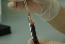 Risk of developing dementia identified through blood molecules Risk of developing dementia identified through blood molecules