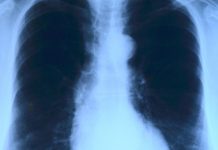 Number of tuberculosis cases falls by over a third in last six years