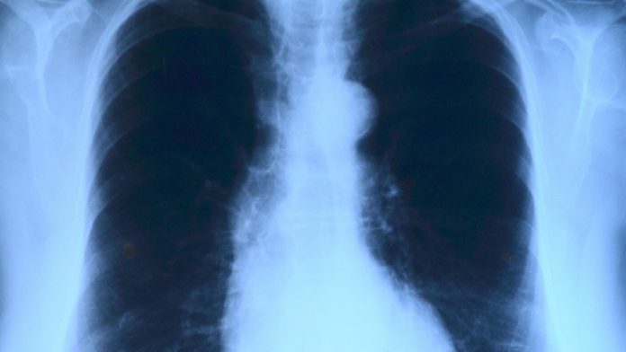 Number of tuberculosis cases falls by over a third in last six years