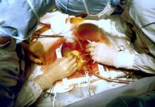 VEST US pivotal trial to evaluate technology for coronary artery bypass VEST US pivotal trial to evaluate technology for coronary artery bypass