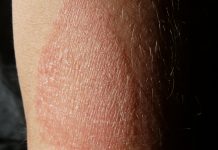 Atopic eczema in adults linked to increased heart problems