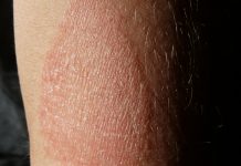Atopic eczema in adults linked to increased heart problems Atopic eczema in adults linked to increased heart problems