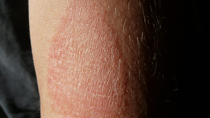 Atopic eczema in adults linked to increased heart problems