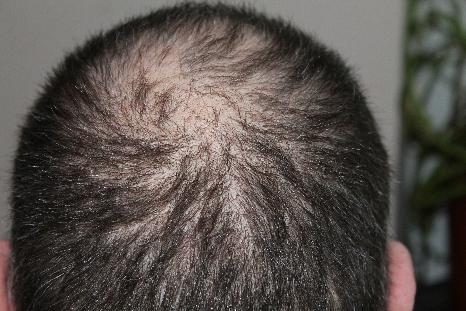 Osteoporosis drug side effects could be key to treating hair loss