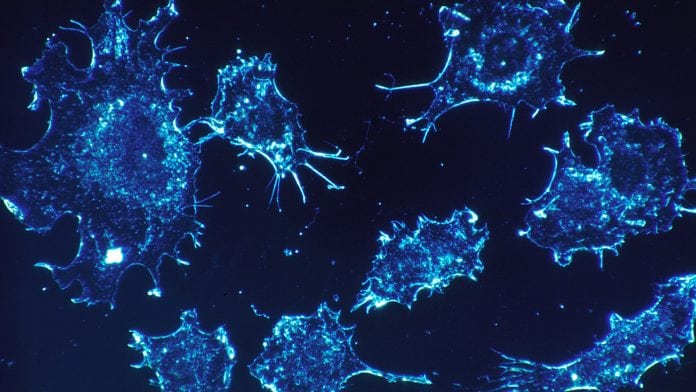 Kidney cancers found stealing other cells to spread around the body Kidney cancers found stealing other cells to spread around the body