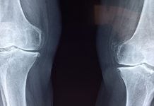 Obesity can increase the risk of osteoarthritis in the hip Obesity can increase the risk of osteoarthritis in the hip