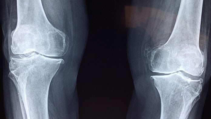 Obesity can increase the risk of osteoarthritis in the hip