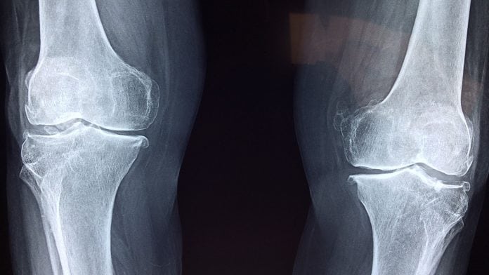 Obesity can increase the risk of osteoarthritis in the hip Obesity can increase the risk of osteoarthritis in the hip