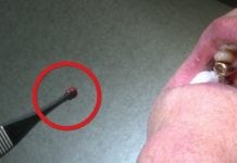 Increased safety in treatment of urethra strictures, thanks to tissue engineering Increased safety in treatment of urethra strictures, thanks to tissue engineering