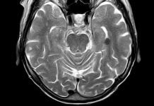 People with traumatic brain injury are at increased risk of dementia People with traumatic brain injury are at increased risk of dementia