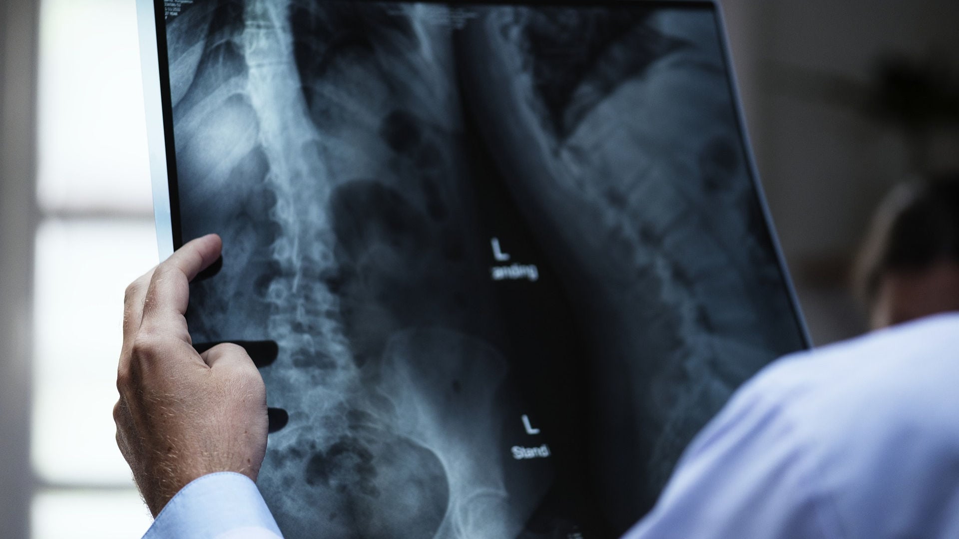 Could osteoporosis be linked to development of dementia