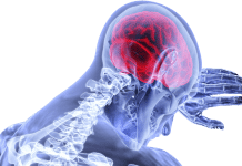 Stroke-related death rates in Europe in decline Stroke-related death rates in Europe on the decline