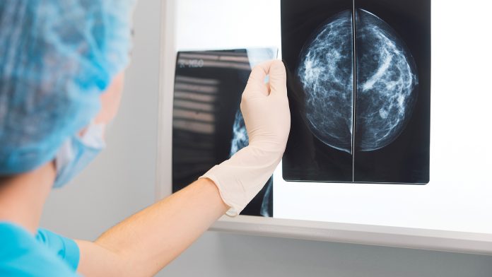 The immune landscape of breast cancer