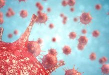 Advanced pancreatic cancer: is killer cell-based immunotherapy a potential cure?