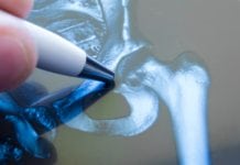 Did you know: many patients aren’t aware of all the hip surgery options? Did you know that many patients aren’t aware of all the hip surgery options?