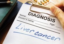 A new drug target for hepatocellular carcinoma A new drug target for hepatocellular carcinoma