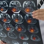 Antiepileptic drugs may increase risk of stroke for those with Alzheimer’s disease