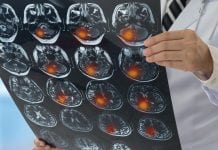 Antiepileptic drugs increase risk of stroke for those with Alzheimer’s disease Antiepileptic drugs may increase risk of stroke for those with Alzheimer’s disease