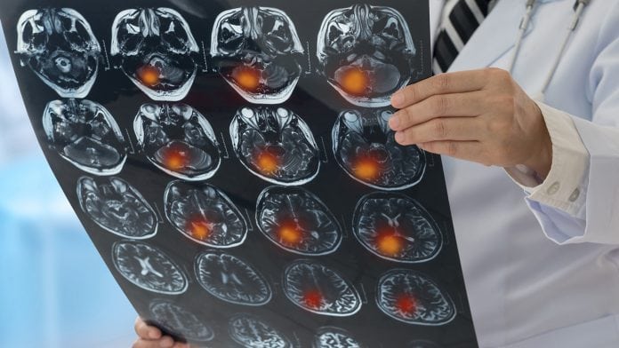 Antiepileptic drugs may increase risk of stroke for those with Alzheimer’s disease