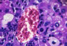 Chronic inflammation linked with various diseases & shorter life expectancy Chronic inflammation linked with various diseases & shorter life expectancy