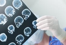 Genetic study points to potential epilepsy therapy Genetic study points to potential epilepsy therapy