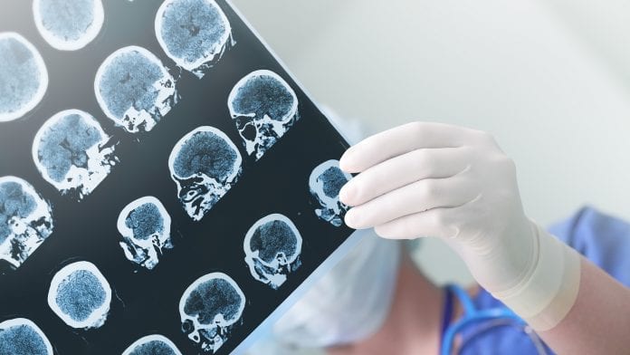 Genetic study points to potential epilepsy therapy