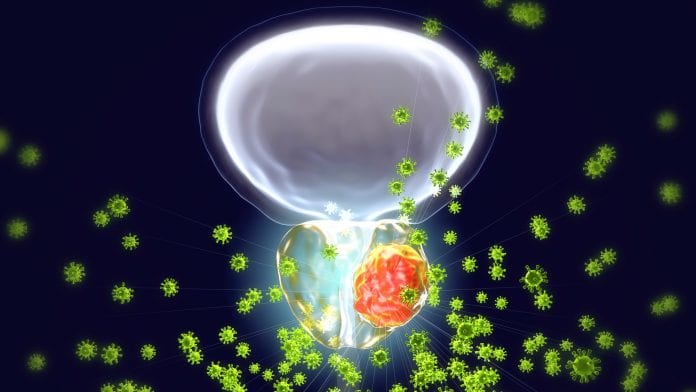 Metastasis in prostate cancer can now be predicted