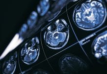 Time to talk about the negative symptoms of schizophrenia Time to talk about the negative symptoms of schizophrenia