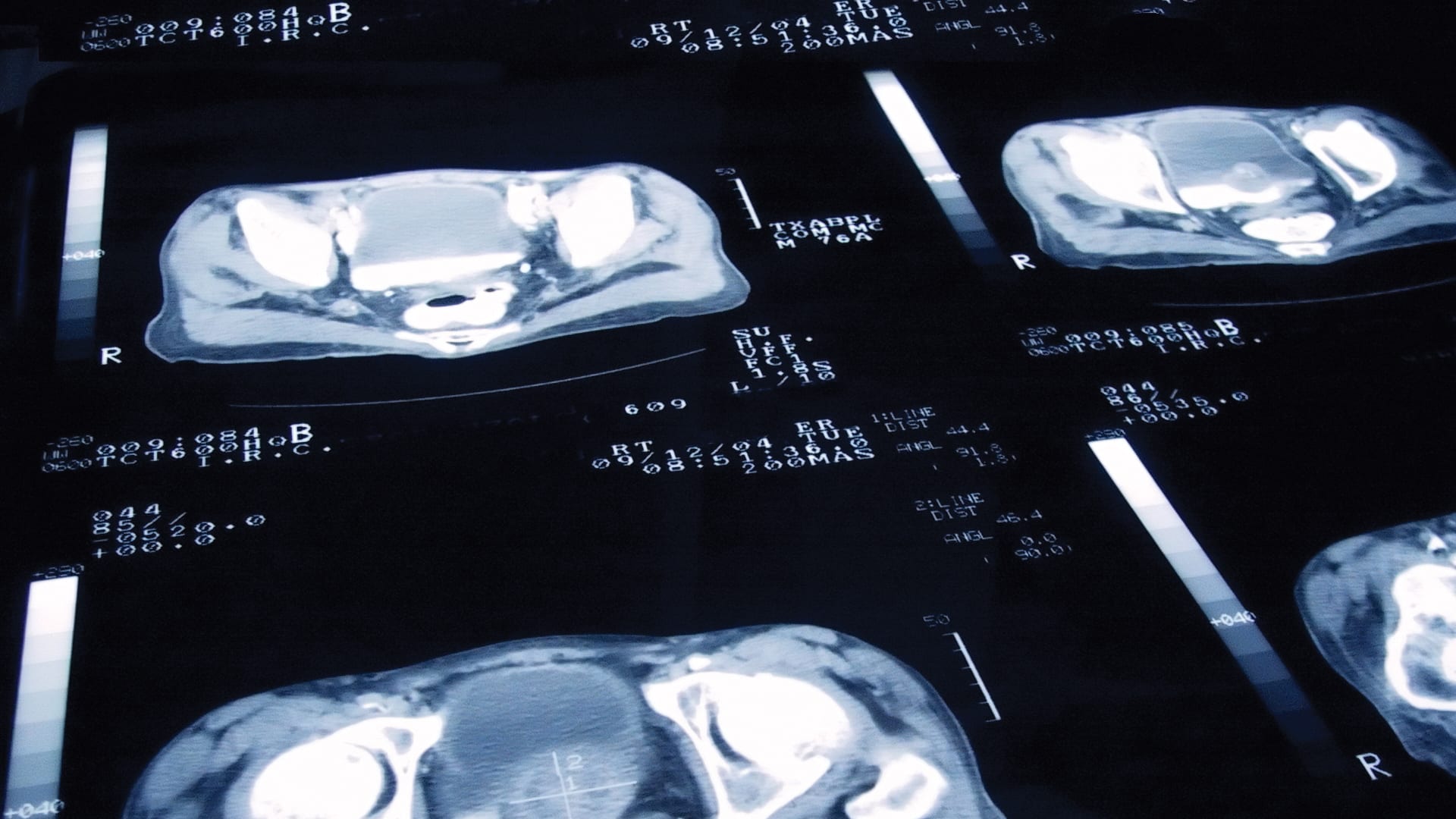 Pioneering the world of prostate cancer with PIONEER