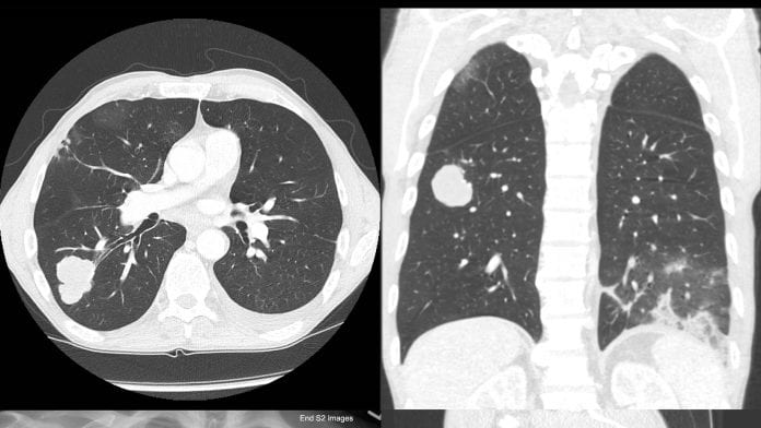 Chest X-ray of Elderly Smoker with Lung Cancer Have researchers found a new approach to treating aggressive cancer?
