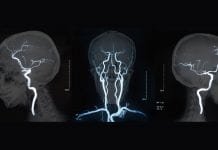 Neuromelanin-sensitive MRI discovered as potential psychosis biomarker
