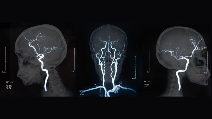 Neuromelanin-sensitive MRI discovered as potential psychosis biomarker