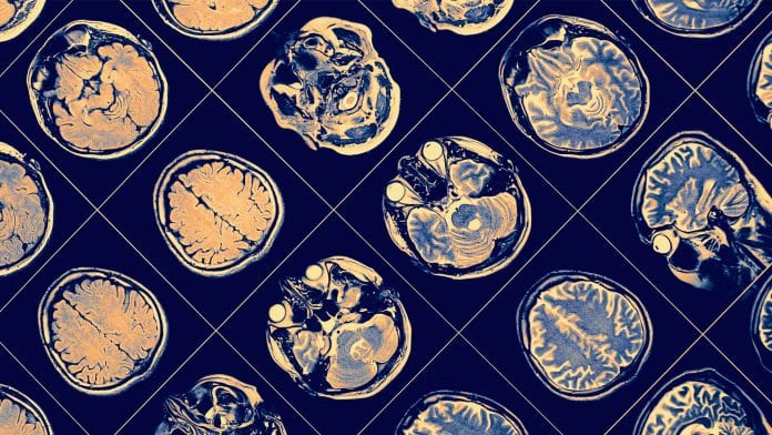 What’s the link between Alzheimer’s disease and head injuries?