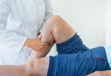 Varicose veins, spider veins, and solutions to both explained
