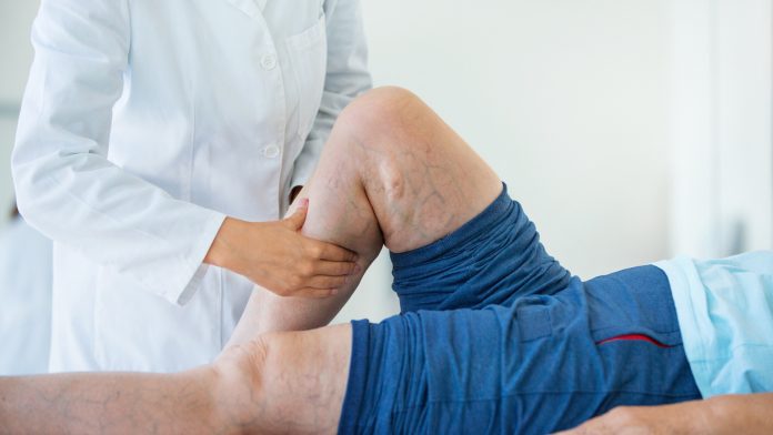 Varicose veins, spider veins, and solutions to both explained