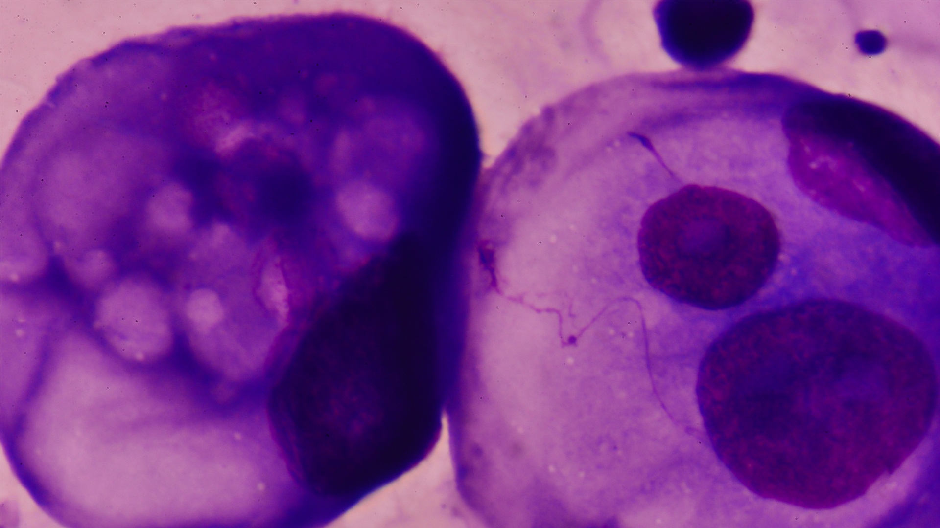 Triple negative breast cancer treatment may be on the horizon