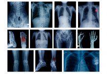 Undiagnosed: are rheumatic and musculoskeletal diseases burdening the European taxpayer? Undiagnosed: are rheumatic and musculoskeletal diseases burdening the European taxpayer?