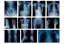 Undiagnosed: are rheumatic and musculoskeletal diseases burdening the European taxpayer?