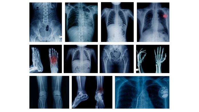 Undiagnosed: are rheumatic and musculoskeletal diseases burdening the European taxpayer?